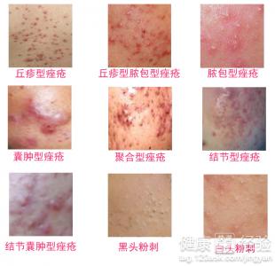 痤疮及毛囊炎的有效治疗方法