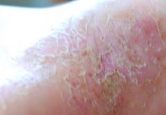 ţƤѢ��������Ҫԭ����ʲô