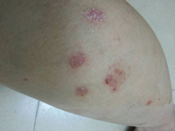 治疗牛皮癣的好医院