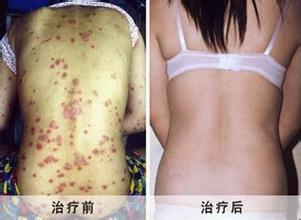 ţƤѢµÄ·¢²¡ÔÒòÊÇʲô