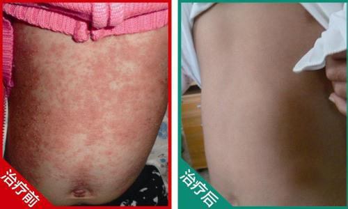 治疗牛皮癣比较好的医院