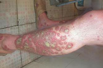 ʲôÔÒò»áÓÕ·¢Å£Æ¤Ñ¢¸´·¢