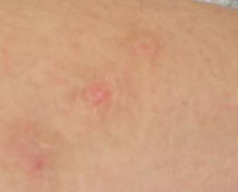 牛皮癣究竟有没有传染性