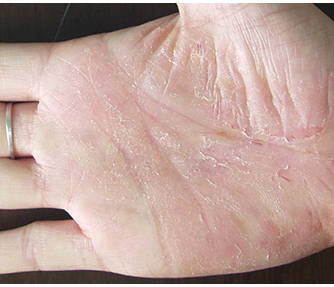 �ֲ���Ƥ��ԭ����ʲô