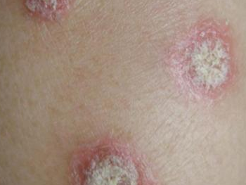 ��ţƤѢ�йصĲ�����ʲô