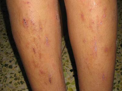 皮肤瘙痒对老人的危害有什么