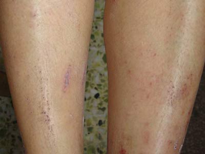 皮肤瘙痒很厉害咋办 皮肤瘙痒很厉害咋办