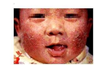 湿疹是怎么引起的呢