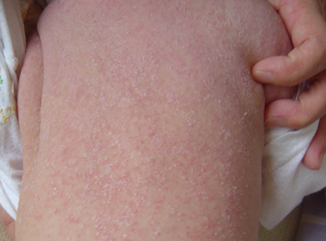 �շ�ʪ����Ĵ�������ʲô