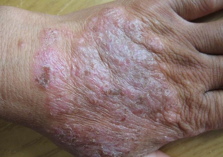 湿疹患者在饮食上要注意什么