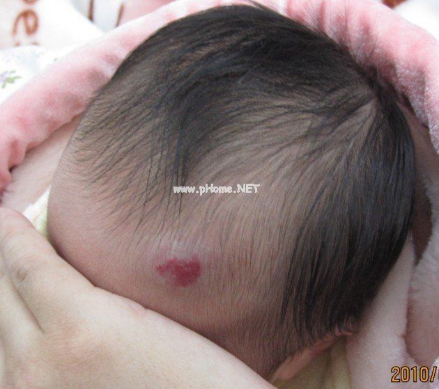 <a href=/xgl/ target=_blank class=infotextkey><a href=/xgl/ target=_blank class=infotextkey>血管瘤</a></a>治疗