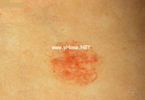 <a href=/xglzl/ target=_blank class=infotextkey><a href=/xglzl/ target=_blank class=infotextkey>血管瘤治疗</a></a>