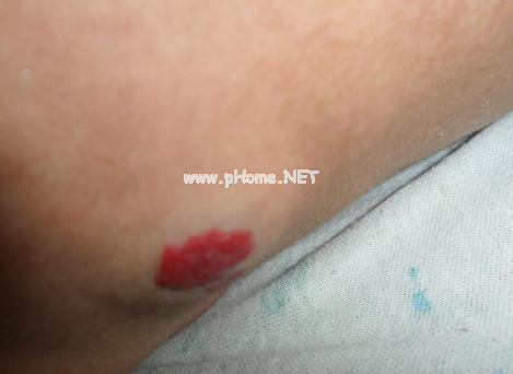 <a href=/xglzl/ target=_blank class=infotextkey><a href=/xglzl/ target=_blank class=infotextkey>血管瘤治疗</a></a>