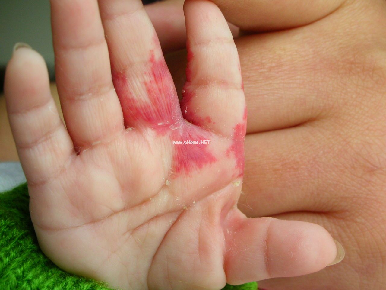 <a href=/xgl/ target=_blank class=infotextkey><a href=/xgl/ target=_blank class=infotextkey>血管瘤</a></a>治疗