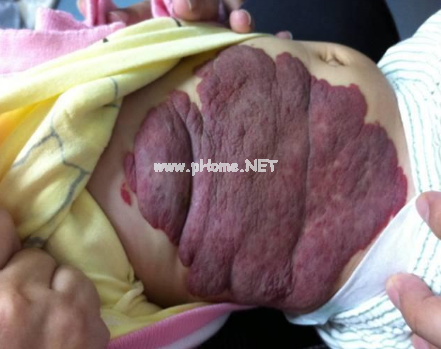 <a href=/xglzl/ target=_blank class=infotextkey><a href=/xglzl/ target=_blank class=infotextkey>血管瘤治疗</a></a>