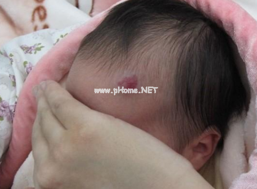 <a href=/xglzl/ target=_blank class=infotextkey><a href=/xglzl/ target=_blank class=infotextkey>血管瘤治疗</a></a>