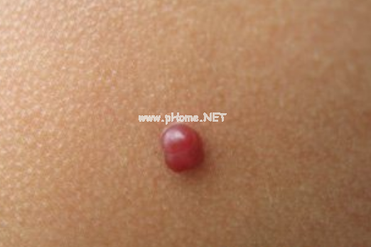 <a href=/xglzl/ target=_blank class=infotextkey><a href=/xglzl/ target=_blank class=infotextkey>血管瘤治疗</a></a>