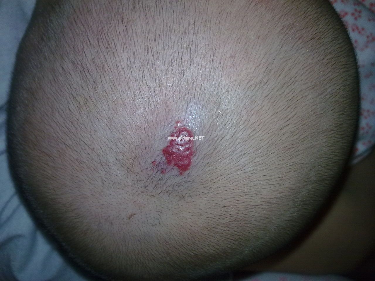 <a href=/xgl/ target=_blank class=infotextkey><a href=/xgl/ target=_blank class=infotextkey>血管瘤</a></a>治疗