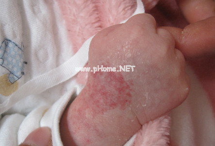 <a href=/xglzl/ target=_blank class=infotextkey><a href=/xglzl/ target=_blank class=infotextkey>血管瘤治疗</a></a>