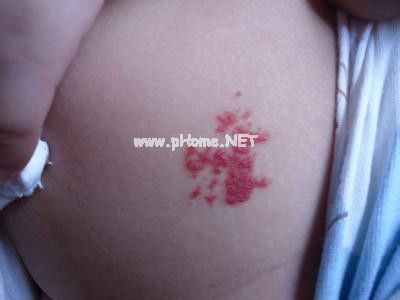 <a href=/xgl/ target=_blank class=infotextkey><a href=/xgl/ target=_blank class=infotextkey>血管瘤</a></a>治疗