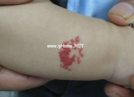 <a href=/xglzl/ target=_blank class=infotextkey><a href=/xglzl/ target=_blank class=infotextkey>血管瘤治疗</a></a>