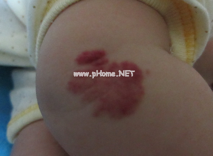 <a href=/xglzl/ target=_blank class=infotextkey><a href=/xglzl/ target=_blank class=infotextkey>血管瘤治疗</a></a>