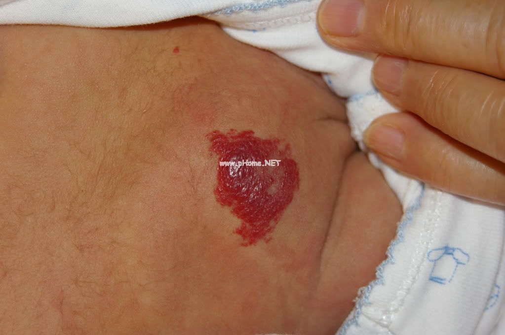 <a href=/xgl/ target=_blank class=infotextkey><a href=/xgl/ target=_blank class=infotextkey>血管瘤</a></a>治疗