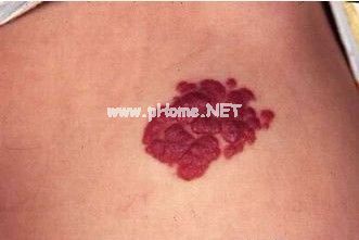 <a href=/xgl/ target=_blank class=infotextkey><a href=/xgl/ target=_blank class=infotextkey>血管瘤</a></a>治疗