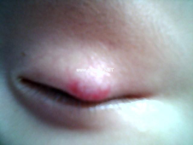 <a href=/xgl/ target=_blank class=infotextkey><a href=/xgl/ target=_blank class=infotextkey>血管瘤</a></a>治疗