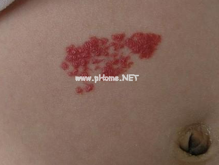 <a href=/xglzl/ target=_blank class=infotextkey><a href=/xglzl/ target=_blank class=infotextkey>血管瘤治疗</a></a>