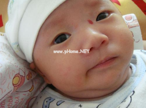 <a href=/xgl/ target=_blank class=infotextkey><a href=/xgl/ target=_blank class=infotextkey>血管瘤</a></a>治疗