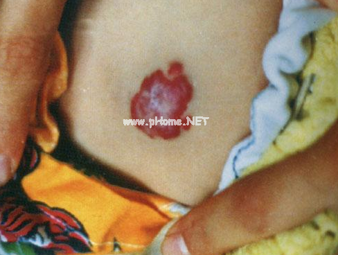 <a href=/xglzl/ target=_blank class=infotextkey><a href=/xglzl/ target=_blank class=infotextkey>血管瘤治疗</a></a>