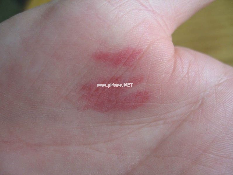 <a href=/xgl/ target=_blank class=infotextkey><a href=/xgl/ target=_blank class=infotextkey>血管瘤</a></a>症状