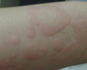 ��ͯݡ�����ʲôҩ