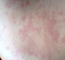 荨麻疹 荨麻疹