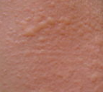 һɫسڶγɵ֢״һƤı棬γɲɵİ߿飬ɫΪɫҲǾֲƤܵƺŻγɵģͨƵķǿ޸ֲƤ֯ģеĻΪγɵ֢״Խ黼ͨרҵֶУôΪʲôŴأ
һԵĽ϶࣬˵֢ҲǾŴԵģŴĻʲΪ֢ڹʳȷӰϴرһЩѹĻߣɴ֢϶࣬Щ棬ǿ˵ŴǲԵģⲿɵĽ϶ࡣ
ŴһЩϵһǸĸд֢Ůͻд֢ģŮϴ֢ĻԼΪ3&#xFF05;ϣеֻǵԵģκμԣеĻҲŴһԴҿɷģͨۺƵķǿõġ
ŴĿԣ̫ԣֻһЩʣҲǲռ󲿷ֵģγɵԭҪһ˻ȷŻγɵģرĻʮҪģҲɴ֢֮һ黼ߴӼ屾ƣſЧ
ͨ˽ԿΪĻģɲǶ˵ӰǽϴģǿͨۺƵİ취УûߵõĿԣûѲʹĥ